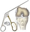 arthroscopy